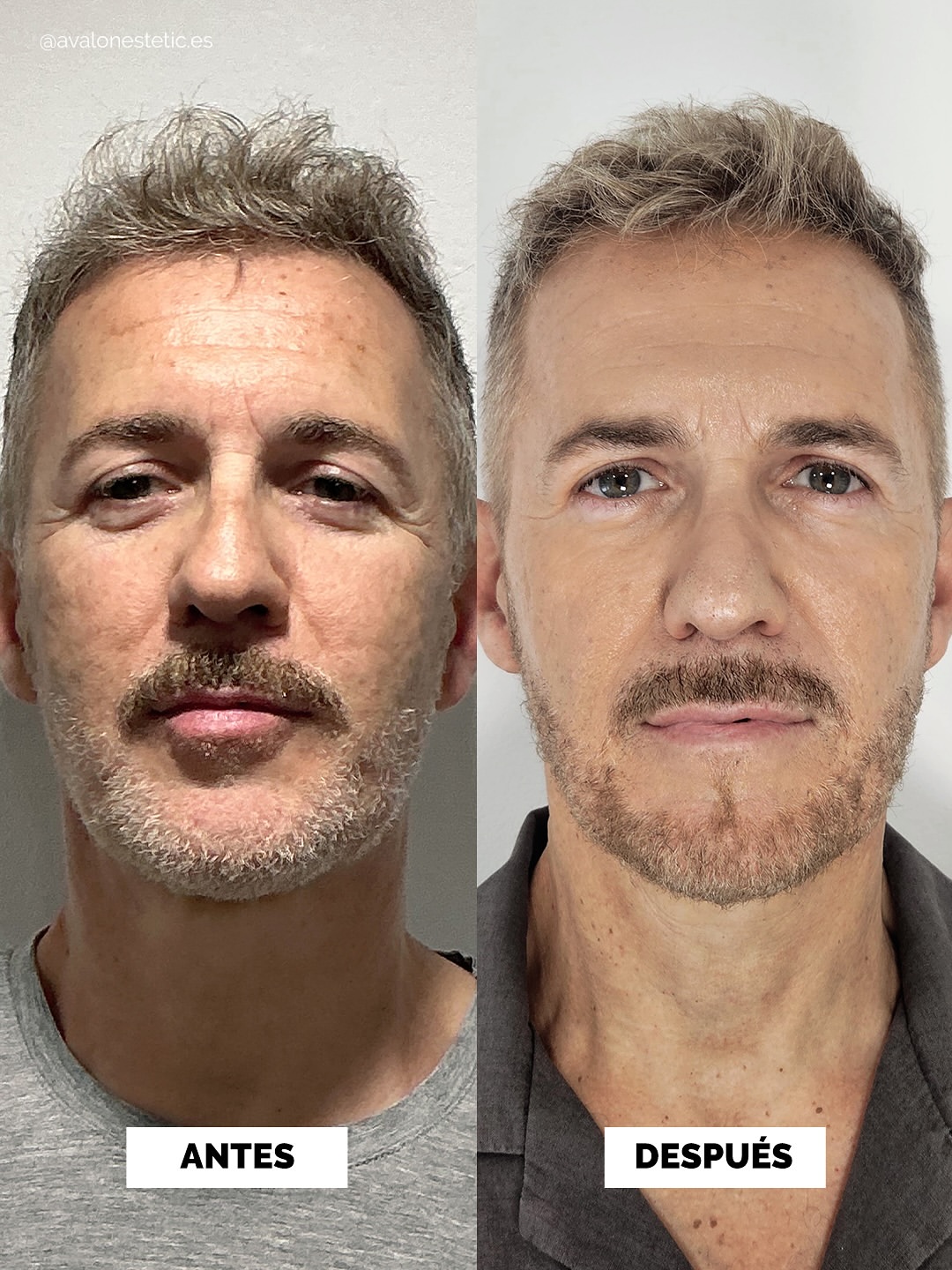 Caso 02 - antes y después Avalon Estetic
