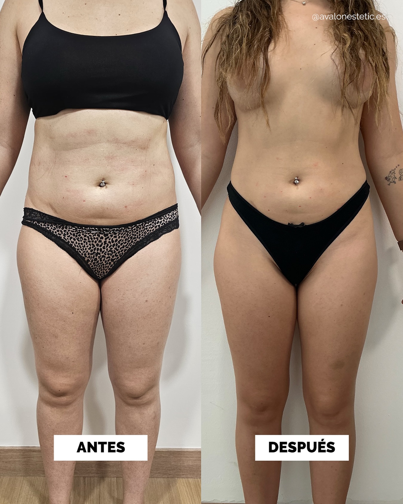 Caso 03 - antes y después Avalon Estetic