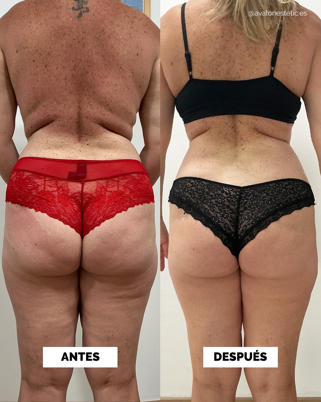Caso 04 - antes y después Avalon Estetic