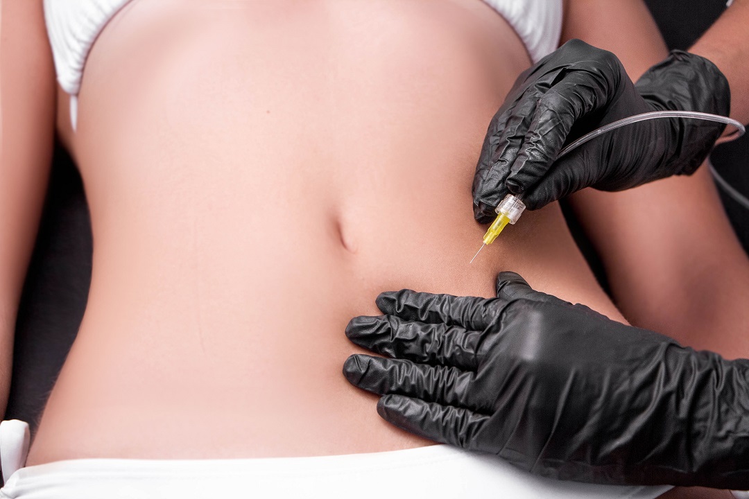 Carboxiterapia